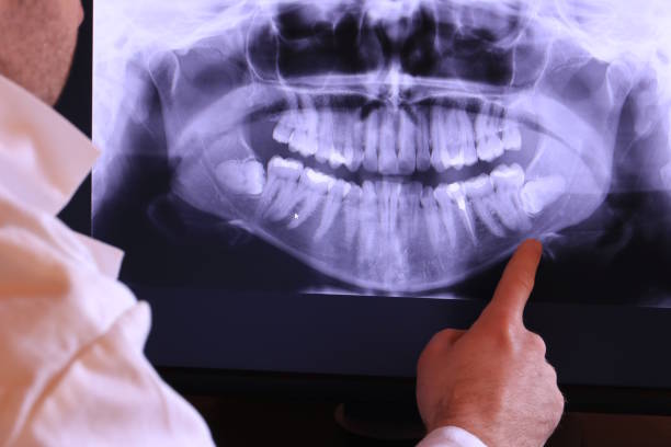Best Emergency Wisdom Tooth Extraction in Coralville, IA
