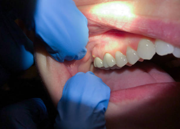 Best Knocked-Out Tooth (Avulsed Tooth) Treatment in Coralville, IA