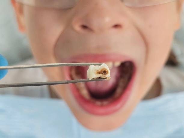 Best Emergency Care for Gum Disease in Coralville, IA