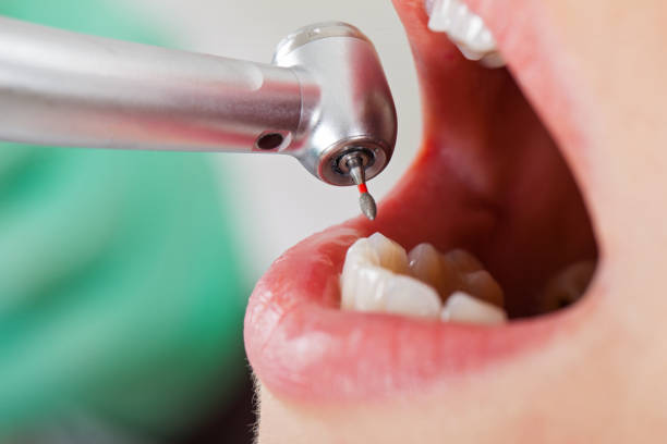 Best Broken or Chipped Tooth Repair in Coralville, IA
